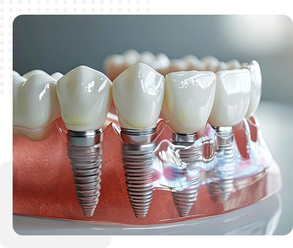 Implant Dental implant model showing the implant in the gum and bone