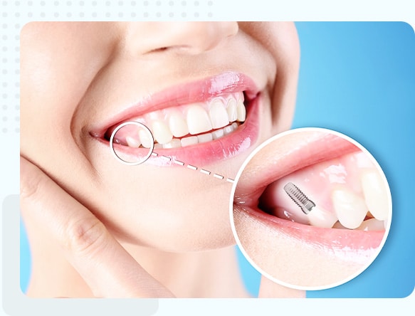 Implant Crown Smiling patient after receiving a dental implant